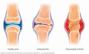 Joint pain