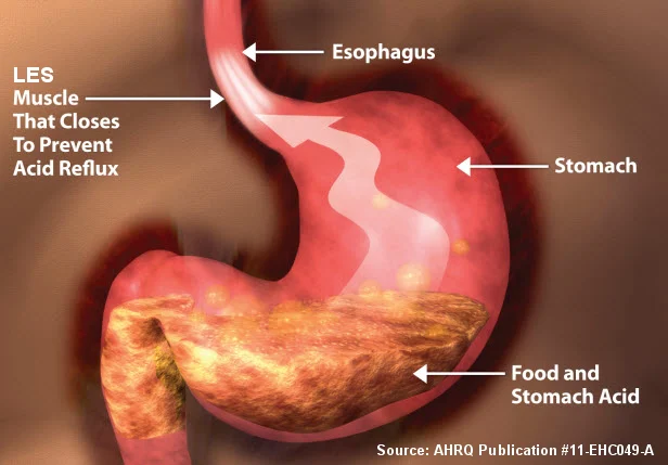 Acid reflux
