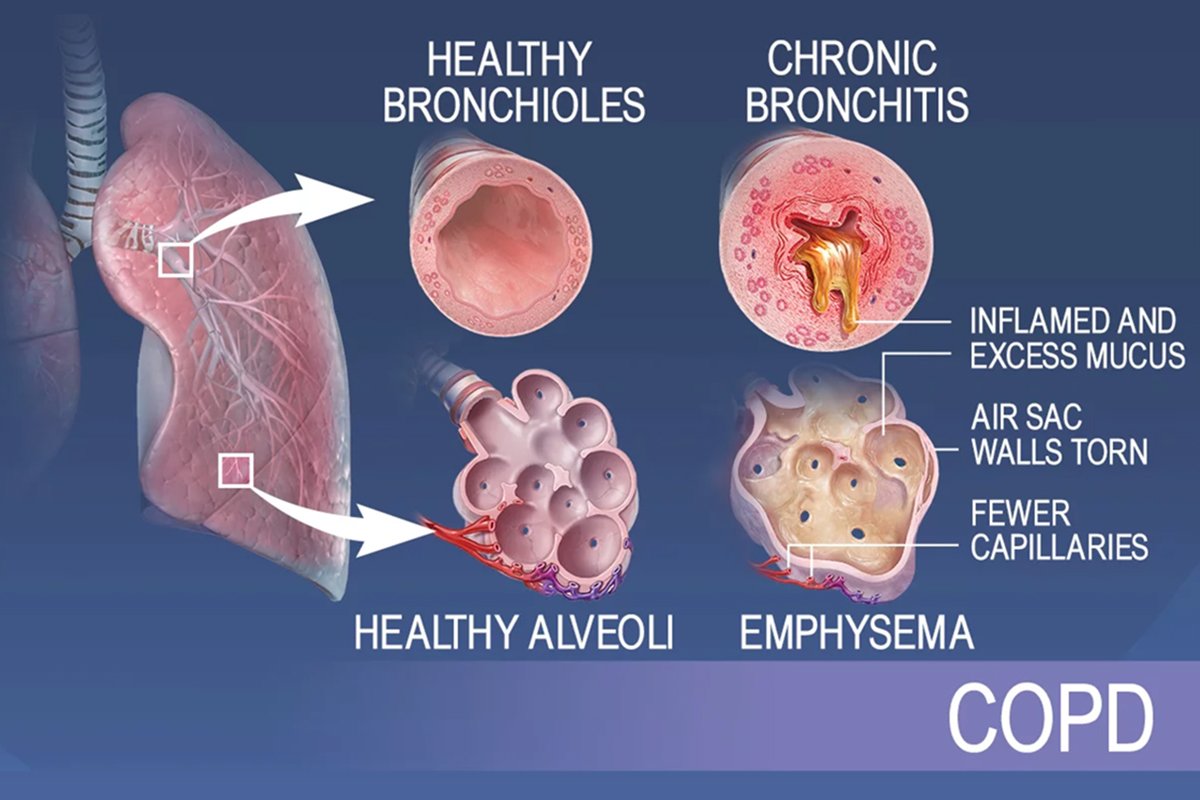 COPD Patient Oxygen Therapy