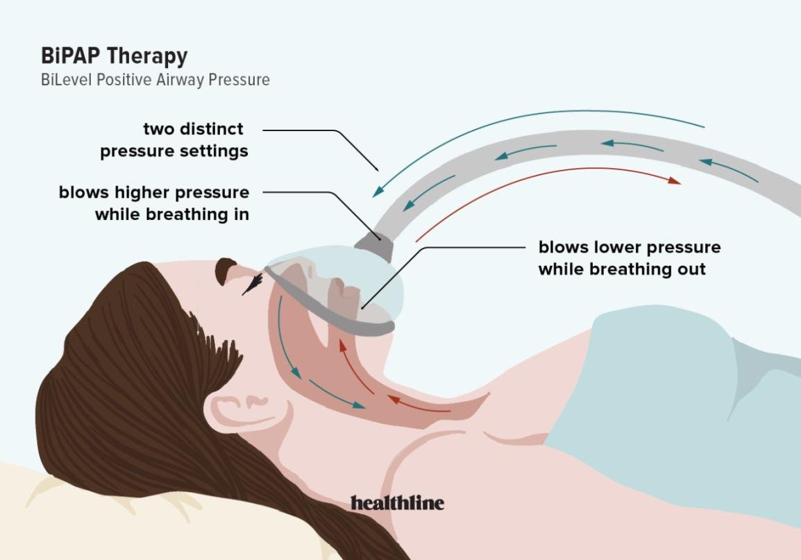 Educational illustration explaining IPAP and EPAP in bilevel ventilation